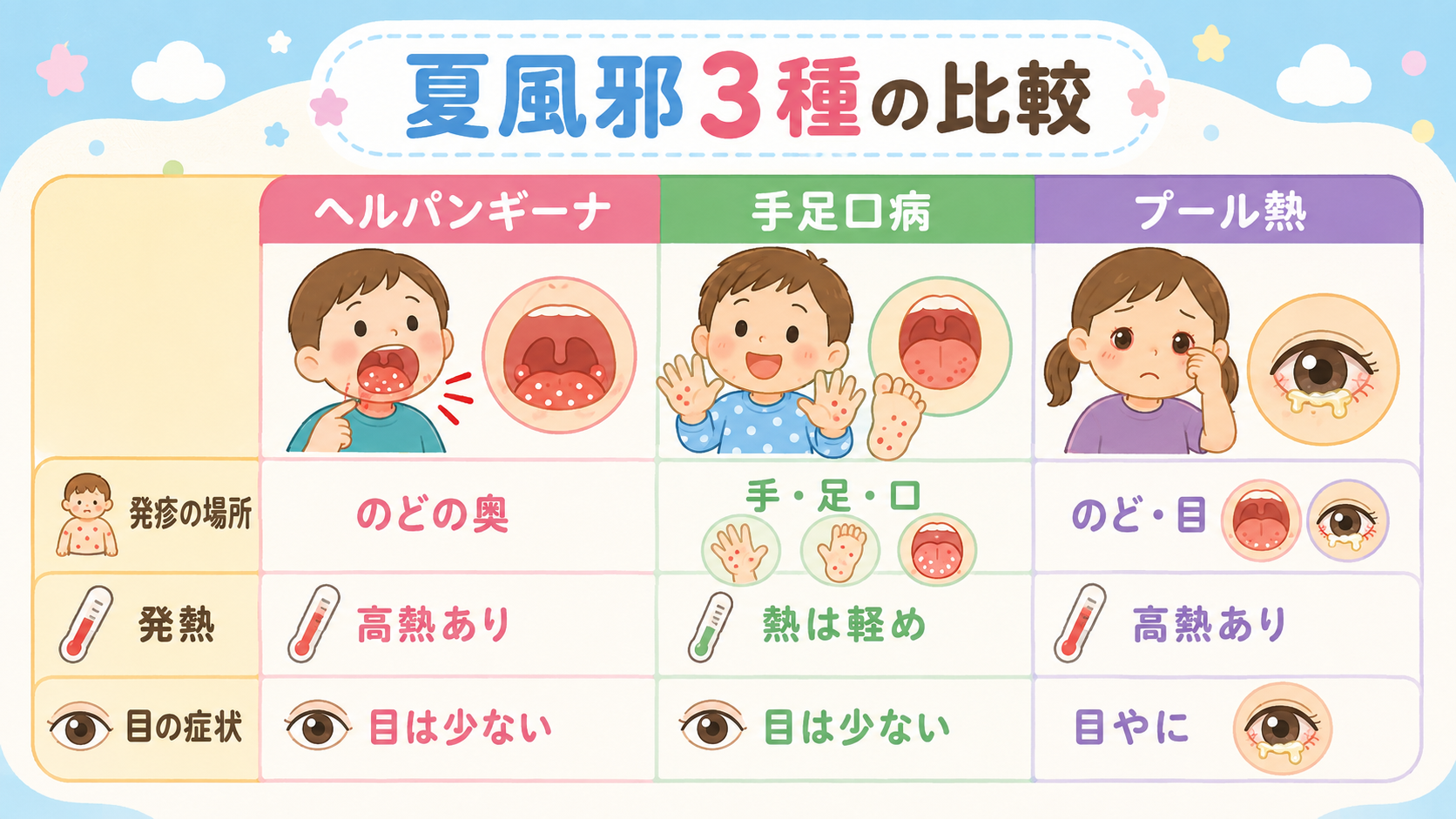 夏風邪3種の比較表イラスト。「ヘルパンギーナ」「手足口病」「プール熱」の3列を並べ、各列に「発疹の場所」「発熱」「目の症状」の行ラベルを付けた見分け早見表。ヘル...